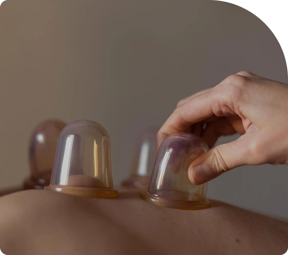 Cupping